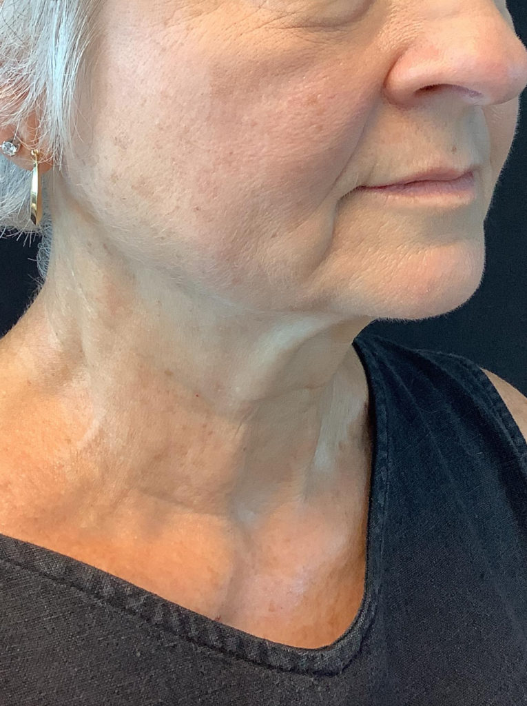 Facelift
