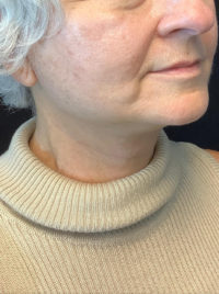 Facelift