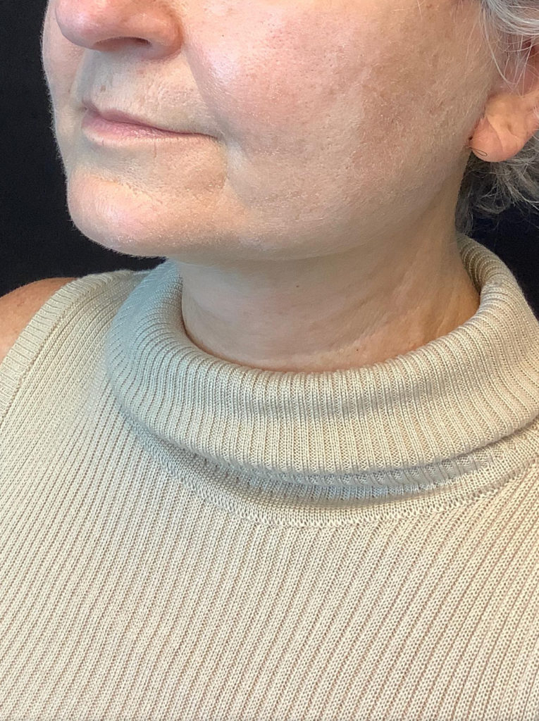 Facelift