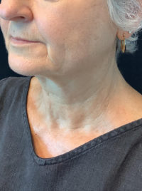 Facelift