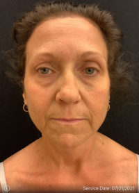 Facelift