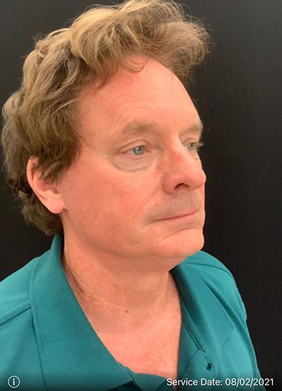 Facelift