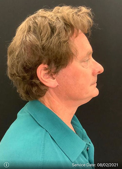 Facelift