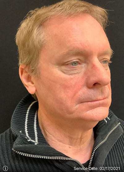 Facelift