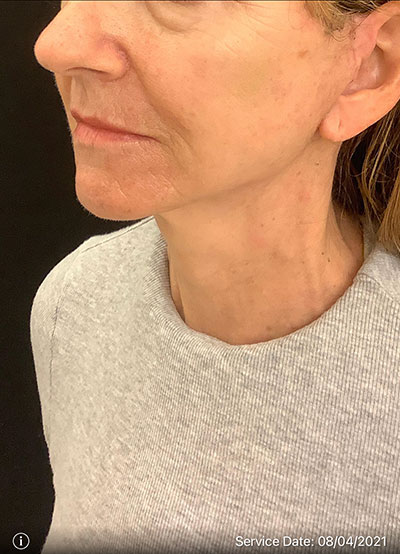 Facelift