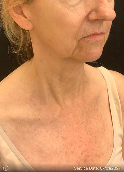 Facelift