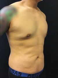 Liposuction