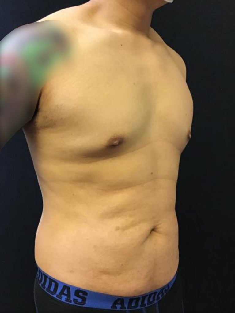 Liposuction