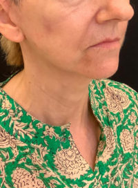 Facelift