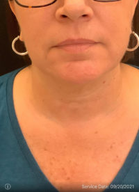 Facetite