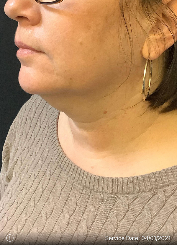 Facetite