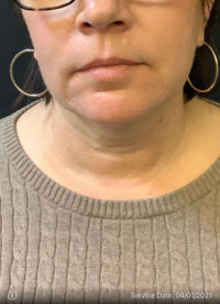 Facetite