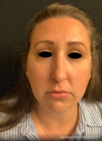 Around The Eye Fillers