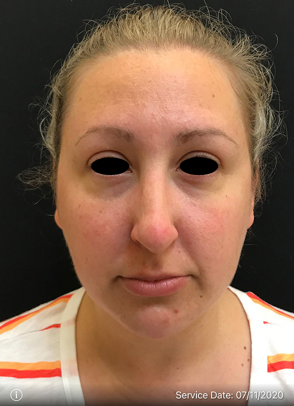 Around The Eye Fillers