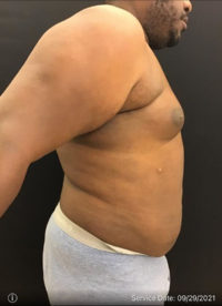 Liposuction