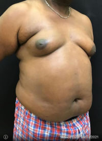 Liposuction