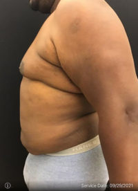 Liposuction