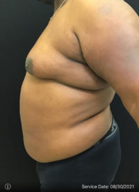Liposuction