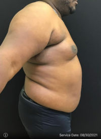 Liposuction