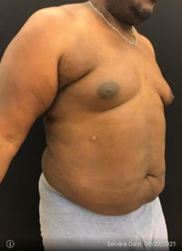 Liposuction