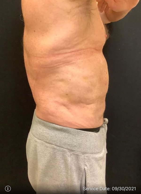 Liposuction