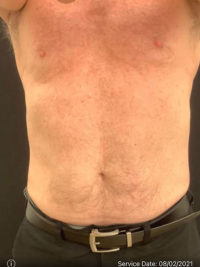 Liposuction