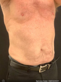 Liposuction