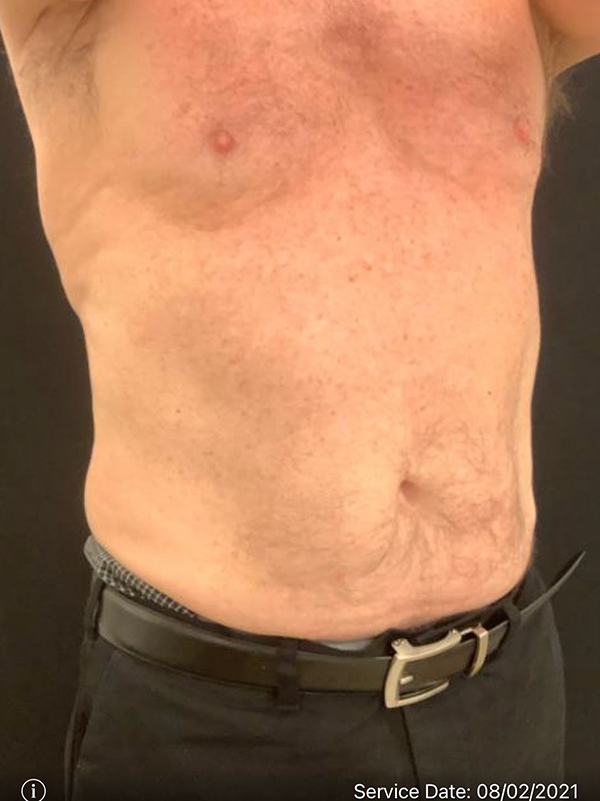 Liposuction