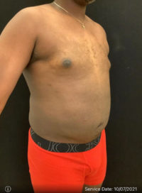 Liposuction