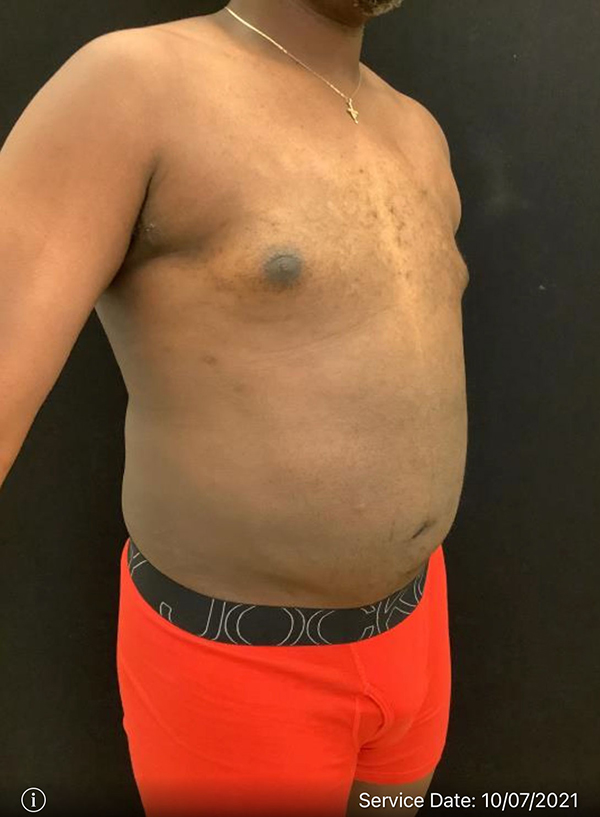 Liposuction