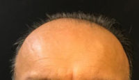 NeoGraft