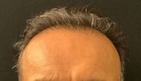 NeoGraft