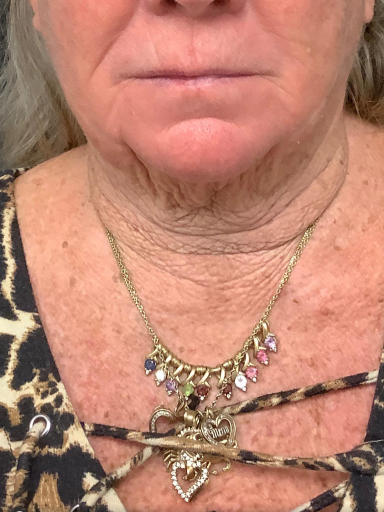 Facelift