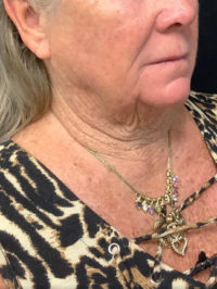 Facelift