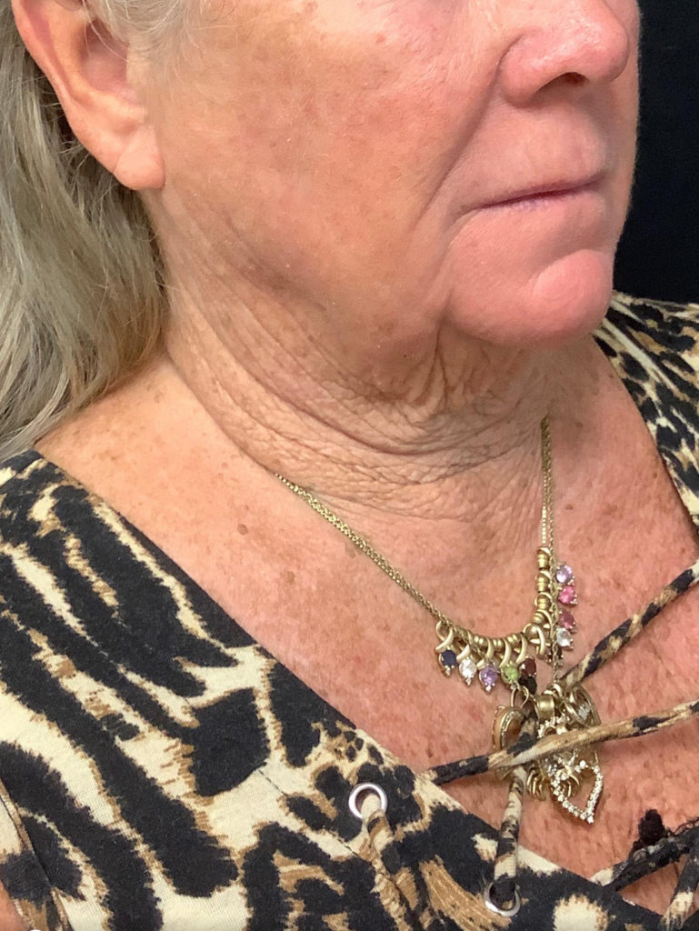 Facelift