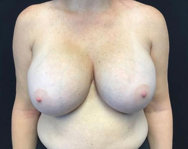 Breast Implant Removal