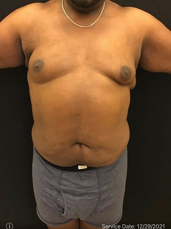 Liposuction