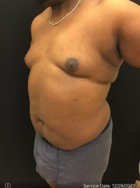 Liposuction