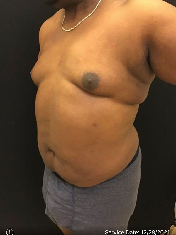 Liposuction