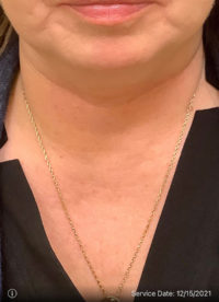 Facetite