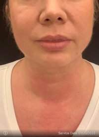 Facetite