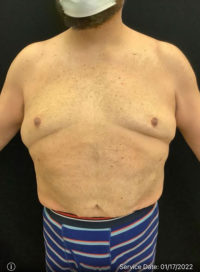 Liposuction