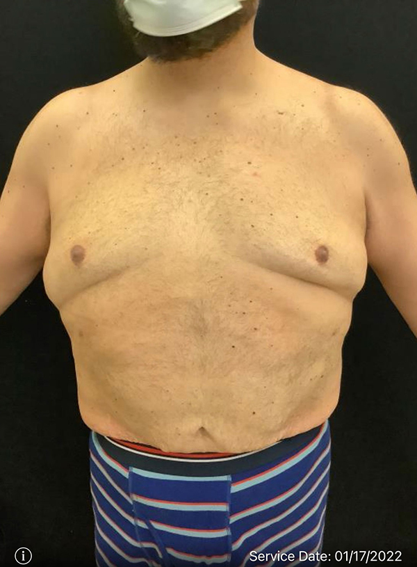 Liposuction