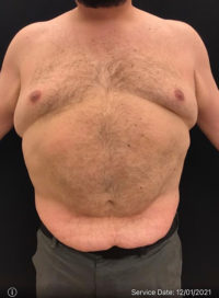 Liposuction