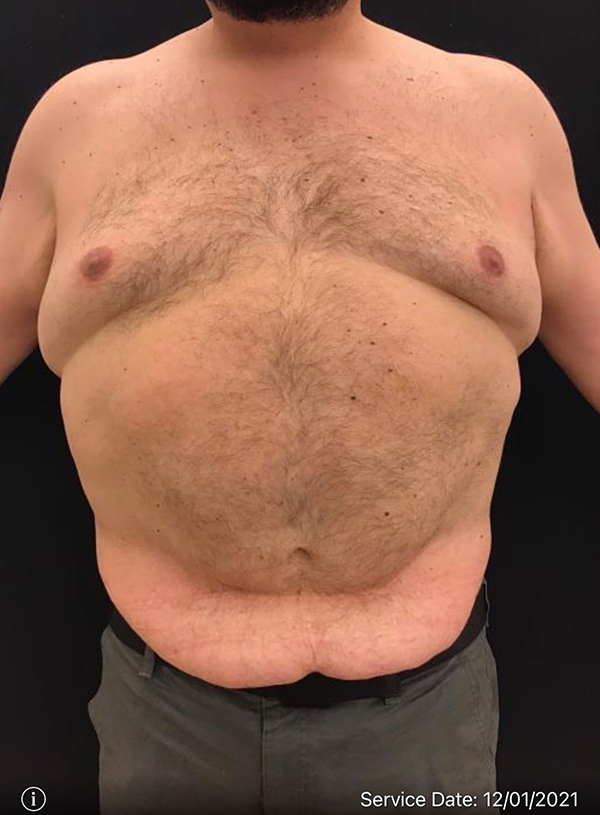 Liposuction