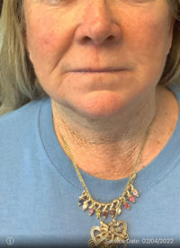 Facelift