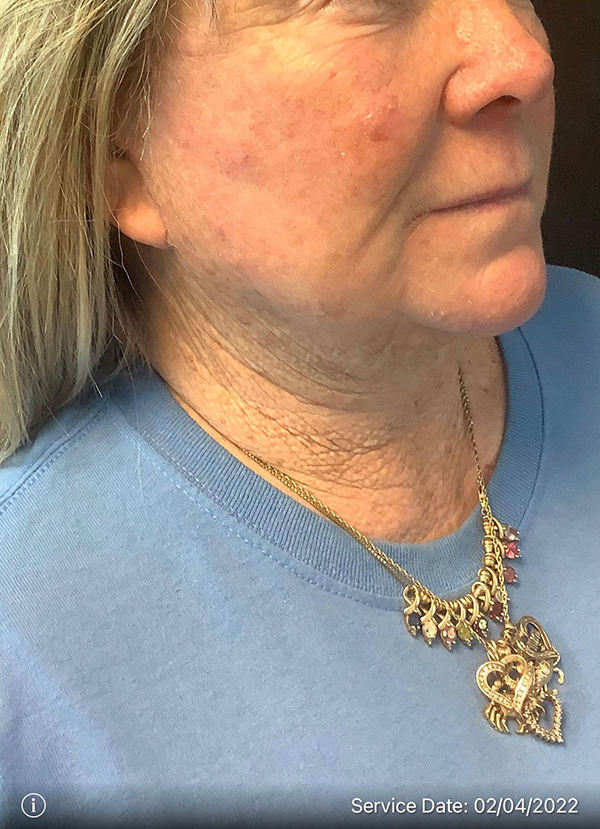 Facelift
