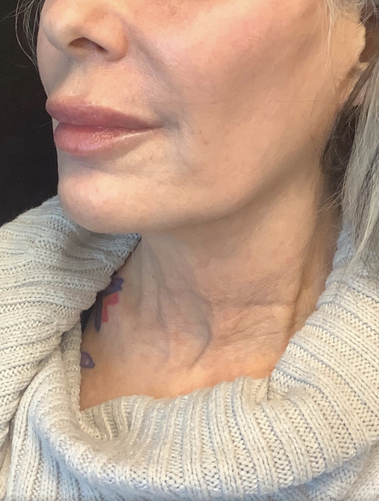 Nouveaulift