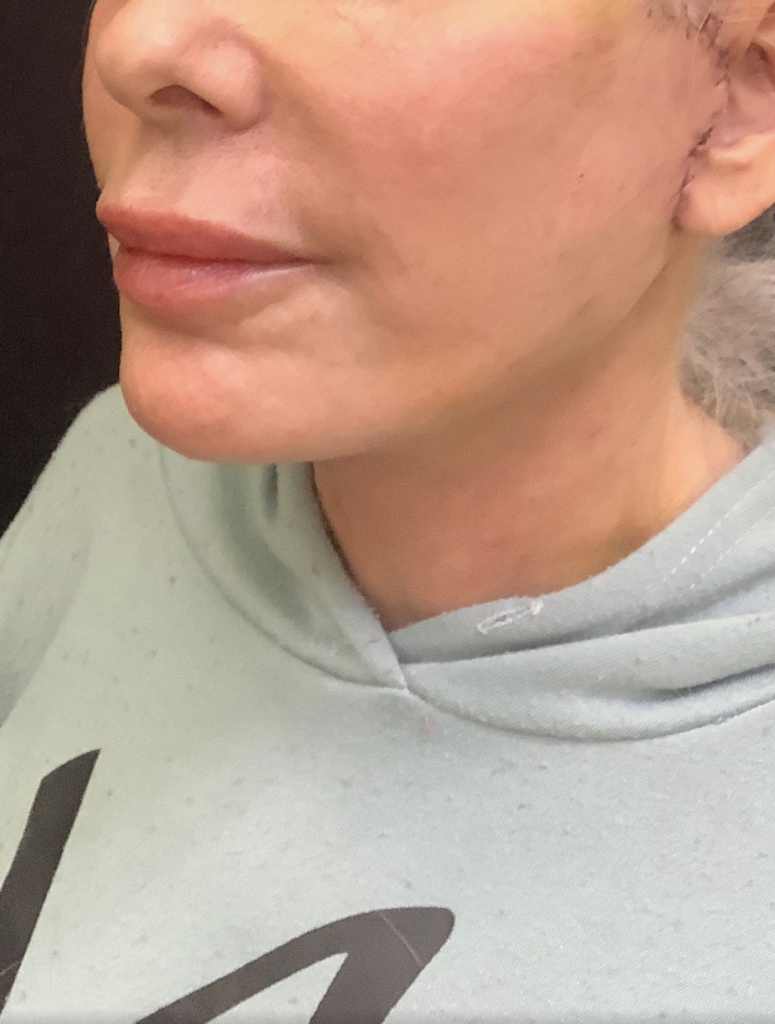 Nouveaulift