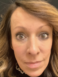 Around The Eye Fillers